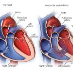 ventriküler septal defekt