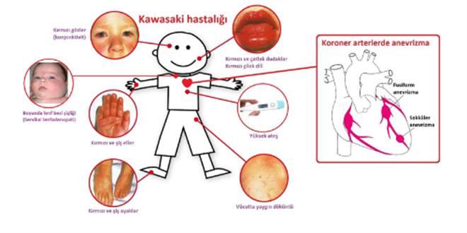 Kawasaki Hastalığı