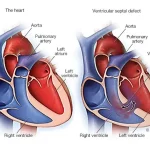 ventriküler septal defekt